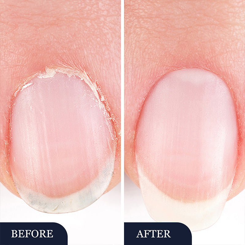 ✨New Arrivals🔥Toenail Fungus Treatment Pen for Damaged Nails